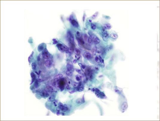 ADENOCARCINOMA OF LUNG