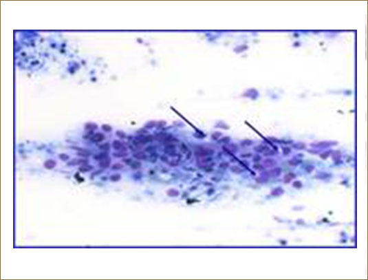 POROCARCINOMA