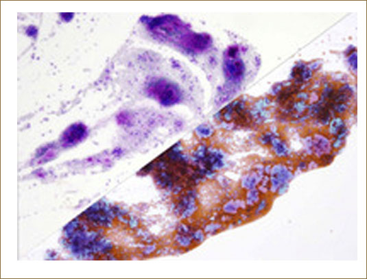 Fine needle aspiration cytology in a case of pleomorphic adenoma of the parotid gland