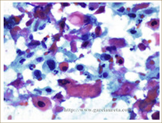Metastatic well-differentiated keratinizing squamous cell carcinoma in a lymph node