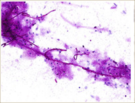 FUNGAL ESOPHAGITIS