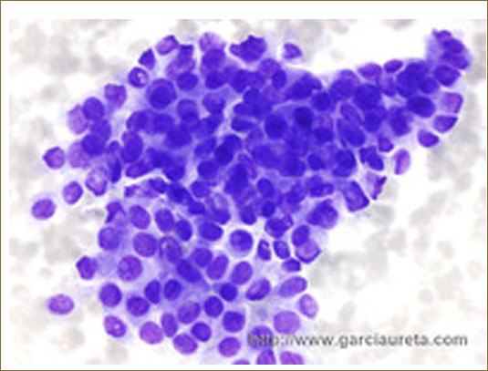 PAPILLARY CARCINOMA OF THYROID