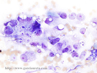 CARCINOMA METASTÁSICO DE PRÓSTATA