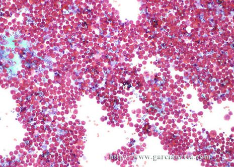 AT low magnification this specimen shows increased cellularity composed of a large population.