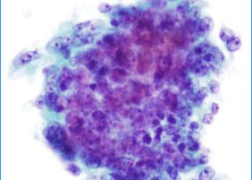 Cell cluster. The cells posses high nucleo cytoplasmic ratios with abnormal chromatin distribution.