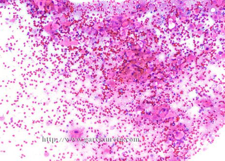 Aspecto xeral dun carcinoma escamoso ben diferenciado nunha mostra de punción aspiración dun ganglio linfático.