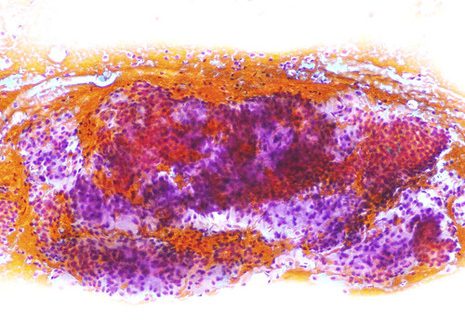 The smears from the FNA of the parotid contained abundant cells.