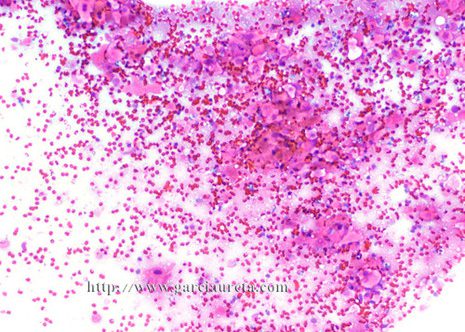 Low power view of well-differentiated squamous cell carcinoma in lymph node FNA smear (Pap stain)