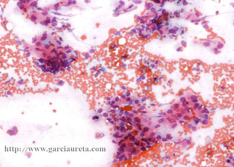 I low-power view of the FNA smears contained numerous round or oval abnormal cells (Pap stain).