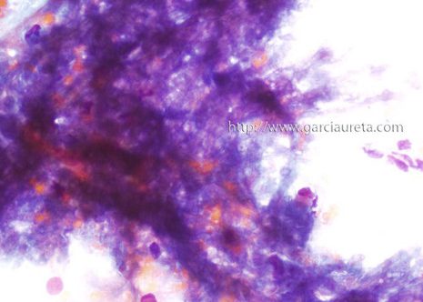 Aspergillus hyhae seen faintly in the Papanicolaou stained of levage fluid.