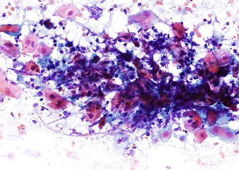 Candiada hyphae forming a tangled mass overlying a plaque of squamous cells, some spores can be seen between the hyphae. Esophageal brushing. Papanicolaou stain