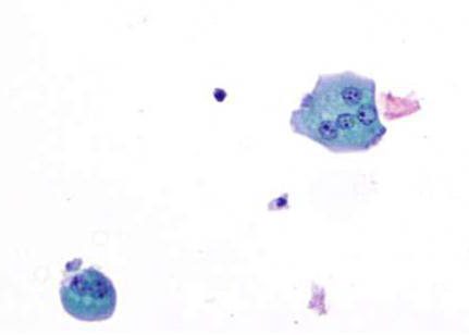 Superficial cells with a multinucleated cell in an umbrella configuration. Large round nuclei, with prominent nucleoli. Papanicolaou stain