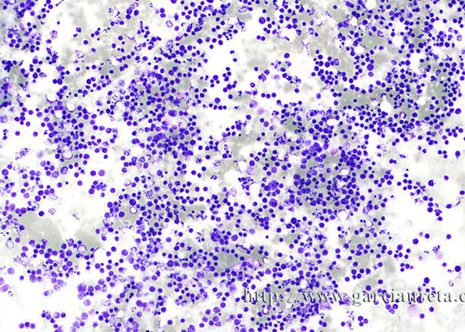 Low power view of the smear showas a very marked cellularity.