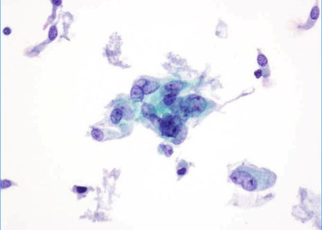 Cells show variation in nuclear size and prominent nucleoli.