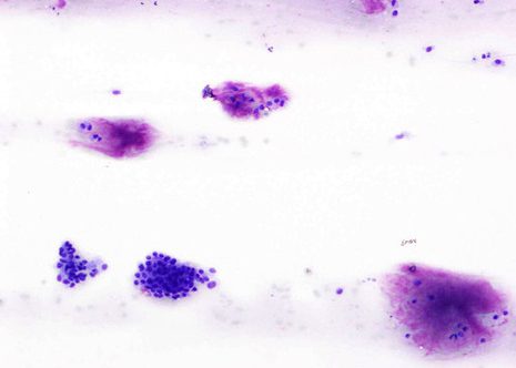 Small groups of epitelial cells and abundant myxoid stroma.