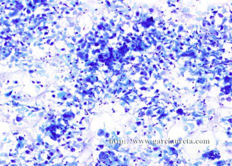 The FNA smears of the lymph node contained numerous abnormal cells lying single in a brackground of cellular debris.