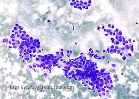 Flat monolayer sheets, dense cytoplasm with well defined cell borders.