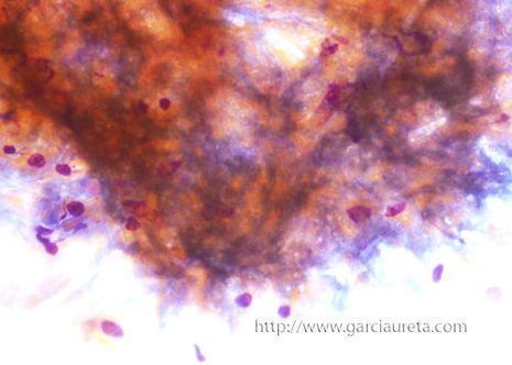 Cytological findings in bronchial lavage material include necrotic and inflammatory debris with fragments of fungal hyphae.