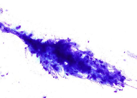 Candiada hyphae forming a tangled mass overlying a plaque of squamous cells, some spores can be seen between the hyphae. Esophageal brushing. MGG stain.