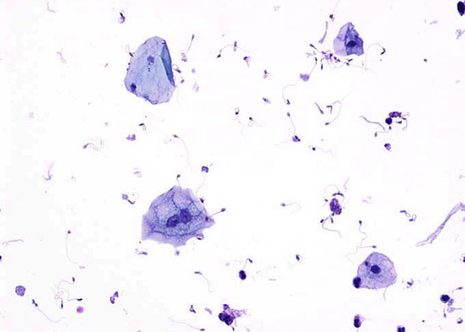 Urothelial and squamous cells in normal voided urine. Cytospin preparation. May-Gruenwald Giemsa ( MGG ) stain