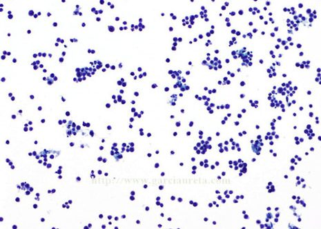 Low-power view of a liquid-based (monolayer) preparation shows isolated abundant cells