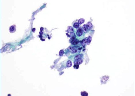 Cluster of cells with moderate cytoplasm, rounded nuclei and prominent nucleoli.