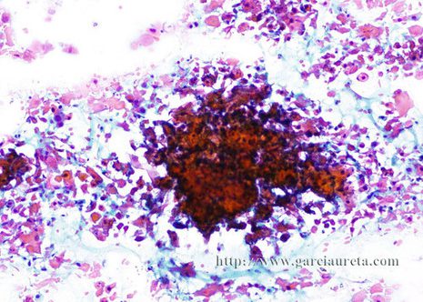 The FNA smears contained abundant cells lying single or in aggregates.