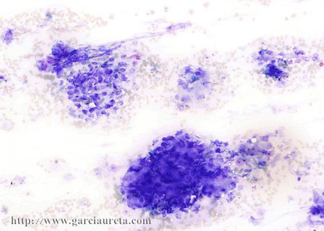 Tumor cells arranged single and in papillary clusters