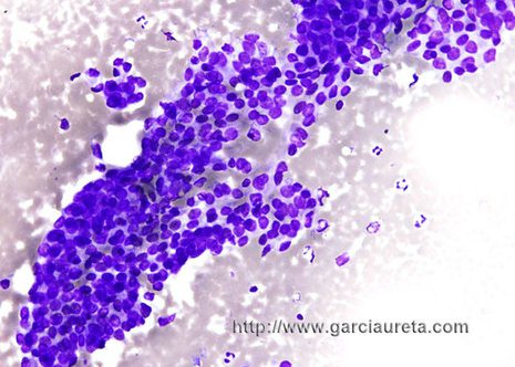 Papillary carcinoma showing a monolayered pattern.