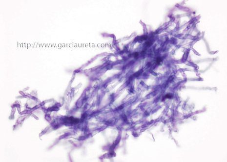 Liquid-based cytology preparation stained using the Papanicolaou stain