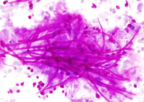 Candiada hyphae forming a tangled mass overlying a plaque of squamous cells, some spores can be seen between the hyphae. Esophageal brushing. PAS stain