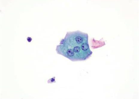 A large multinucleated urothelial cell of the type seen most commonly in uretal and pelvic washing. Papanicolaou stain