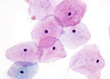 Estrogenic effects are manifested by the appearance of large falt dissociated eosinophilic superficial squamous cells in a clean background.
