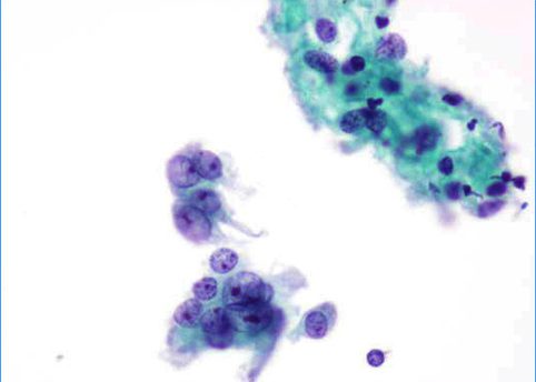 Groups of moderately pleomorphic glandular cells.