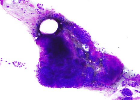 Aspirate showing a large cohesive sheet of small epithelial cells surrounded by stromal