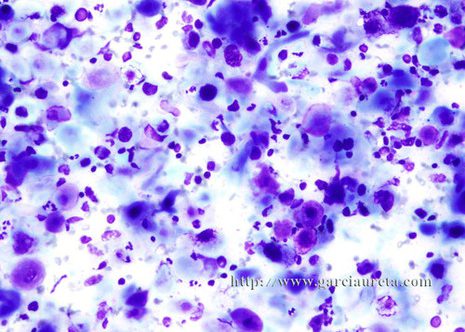 Malignant epithelial cells and a background of lymphocytes.