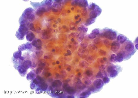 Aggregate of malignant cells with marked nuclear enlargement.