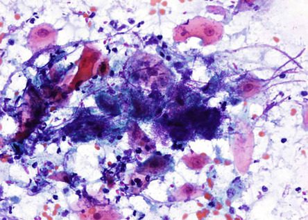 A mixture of yeast forms and hyphal forms is present with little inflammatory response. Esophageal brushing.Papanicolaou stain