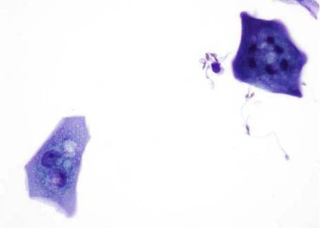 Urothelial cells with prominently vacuolated cytoplasm. ( MGG ) stain