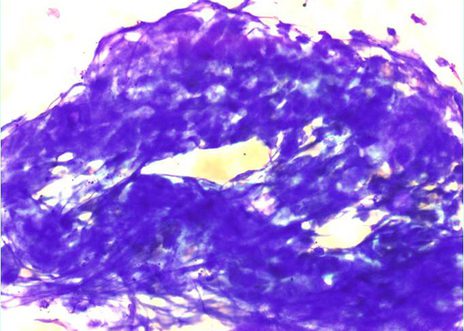 Agregate of small cells with a small amount of cytoplasm, the nuclei are difficult to examine but appear hyperchromatic.
