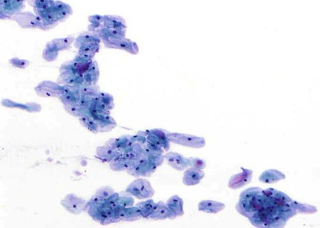 Intermediate cells in cervical smear.