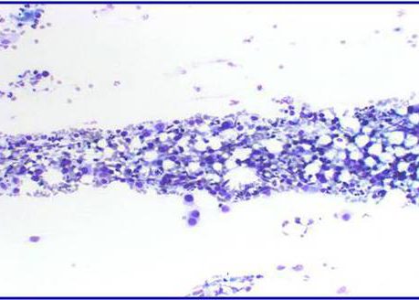 Dispersed cells population of numerous small epithelial cells.