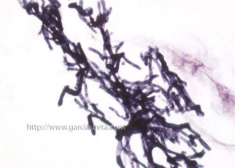 Hifas de Aspergillus en líquido de lavado bronquial tinguidos con técnica Grocott