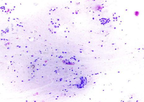 pleomorphic adenoma cytology