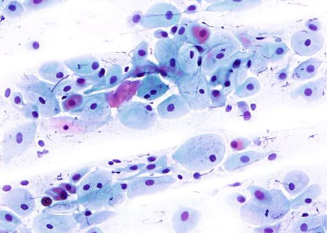 Células parabasais. Células redondas ou ovales con núcleo relativamente agrandado e citoplasma denso, escaso e cianófilo.