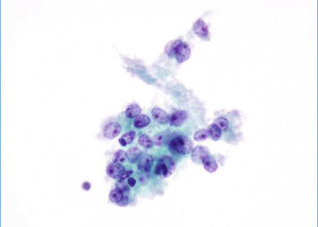 Grupo de células con delicado citoplasma.