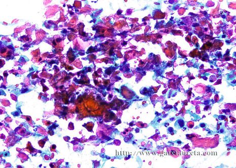 Keratinised anucleate squamous cells irregular shapes and staining reactions.