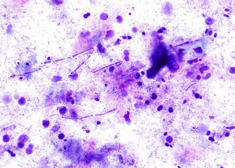 A mixture of yeast forms and hyphal forms is present with little inflammatory response. Esophageal brushing. Esophageal brushing M.G.G. stain