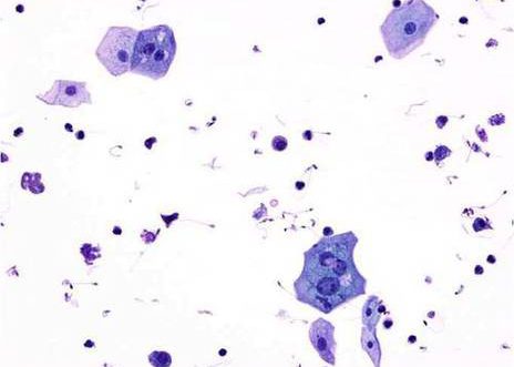 Urine voided: benign cells. The superficial squamous cells with small nuclei and abundant cytoplasm are admixed with a few inflammatory cells. ( MGG ) stain