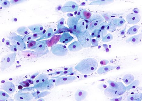 Parabasal cells. Round to oval cells with relatively large nuclei an scant dense, cyanophilic cytoplasm.